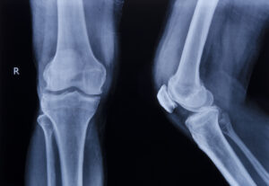 Broken Bones in Lake Charles, LA