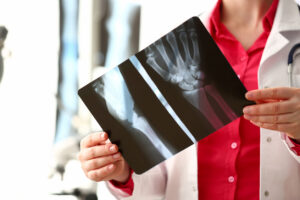 Nerve Damage